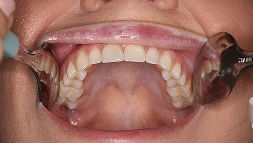 Upper Teeth (occlusal)