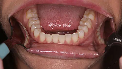 Lower Teeth (occlusal)